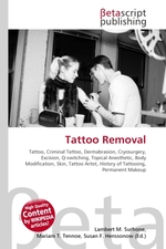 Tattoo Removal