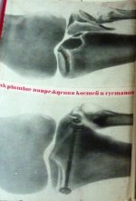 Закрытые повреждения костей и суставов:2-е издание
