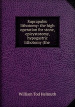 Suprapubic lithotomy: the high operation for stone, epicystotomy, hypogastric lithotomy (the
