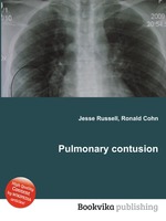 Pulmonary contusion