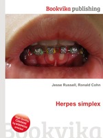 Herpes simplex