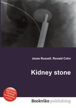 Kidney stone