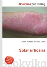 Solar urticaria