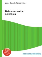 Balo concentric sclerosis