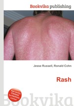 Rash