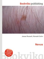 Nevus