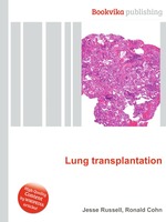 Lung transplantation