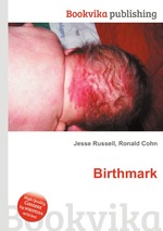 Birthmark