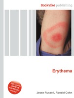 Erythema