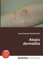 Atopic dermatitis