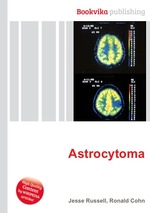 Astrocytoma