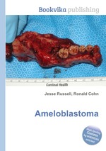 Ameloblastoma