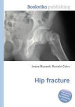 Hip fracture