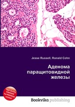 Аденома паращитовидной железы