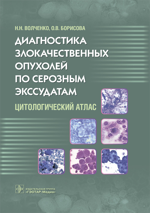 Диагностика злокачественных опухолей по серозным экссудатам (эл.версия)