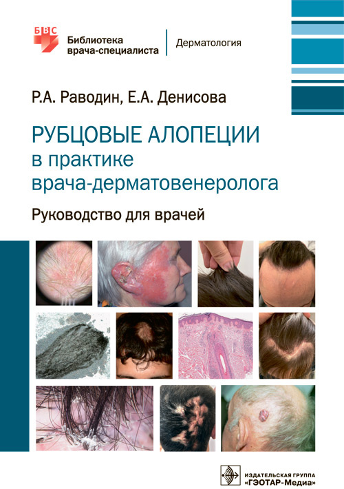 Рубцовые алопеции в практике врача-дерматовенеролога : руководство для врачей / Р. А. Раводин, Е. А. Денисова. — Москва : ГЭОТАР-Медиа, 2021. — 112 с. : ил. — (Серия «Библиотека врача-специалиста»)