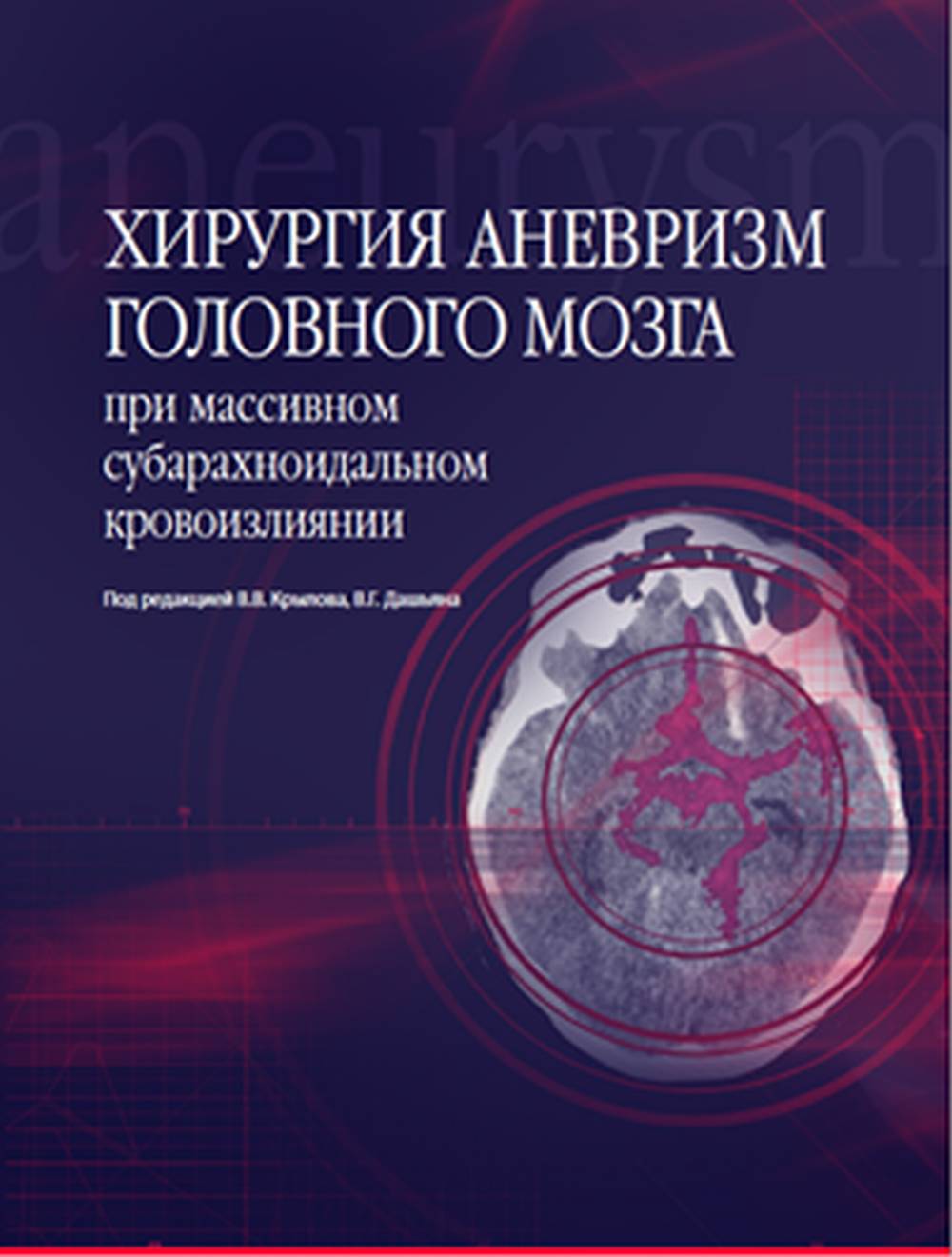 Хирургия аневризм головного мозга. При массивном субарахноидальном кровоизлиянии