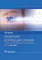 Лазерная коррекция зрения и этот загадочный инновационный метод ReLEx SMILE