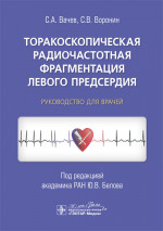 Торакоскопическая радиочастотная Фрагментация левого предсердия