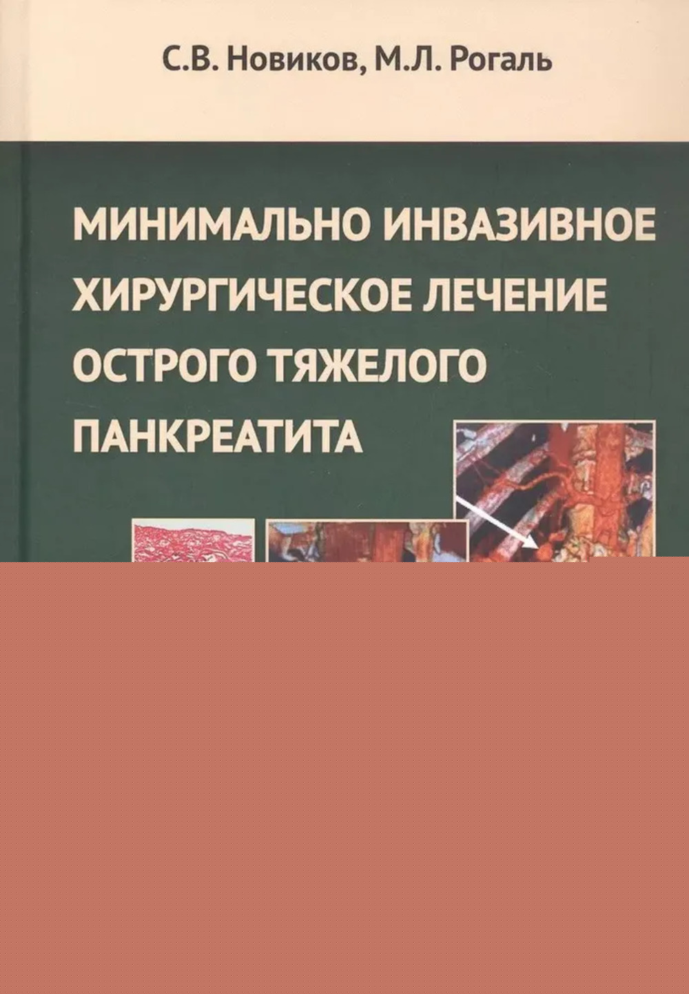 Минимальное инвазивное хирургическое лечение острого тяжелого панкреатита